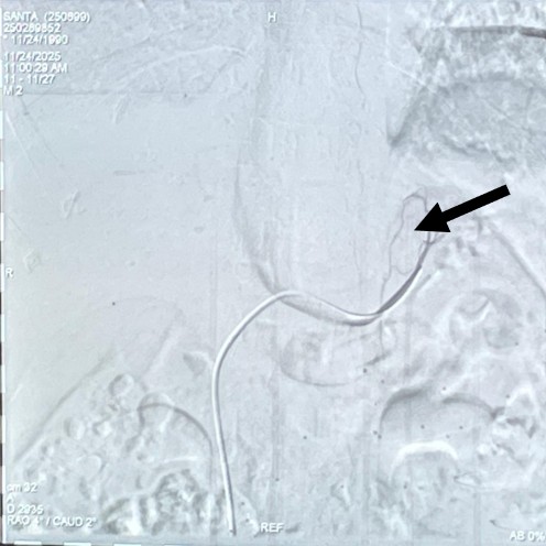 Adrenal venous sampling: arrow showing the left adrenal vein during the procedure